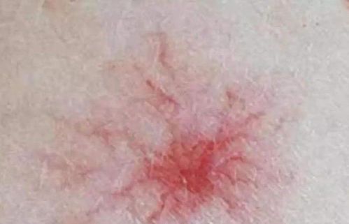 蜘蛛网痣：症状、成因与识别方法